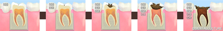むし歯の発生と進行