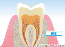 根管治療