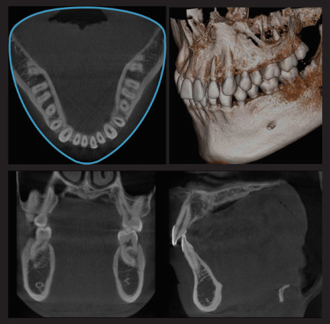 歯科用CT