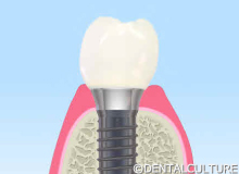 インプラント