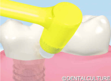 治療後の歯磨きと定期健診